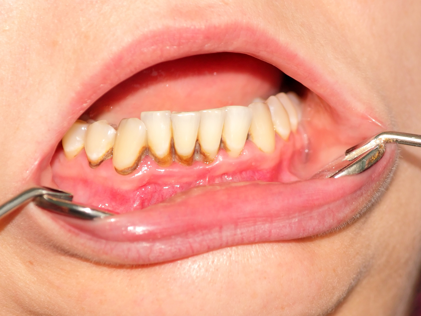 How can I remove tartar from my teeth naturally?