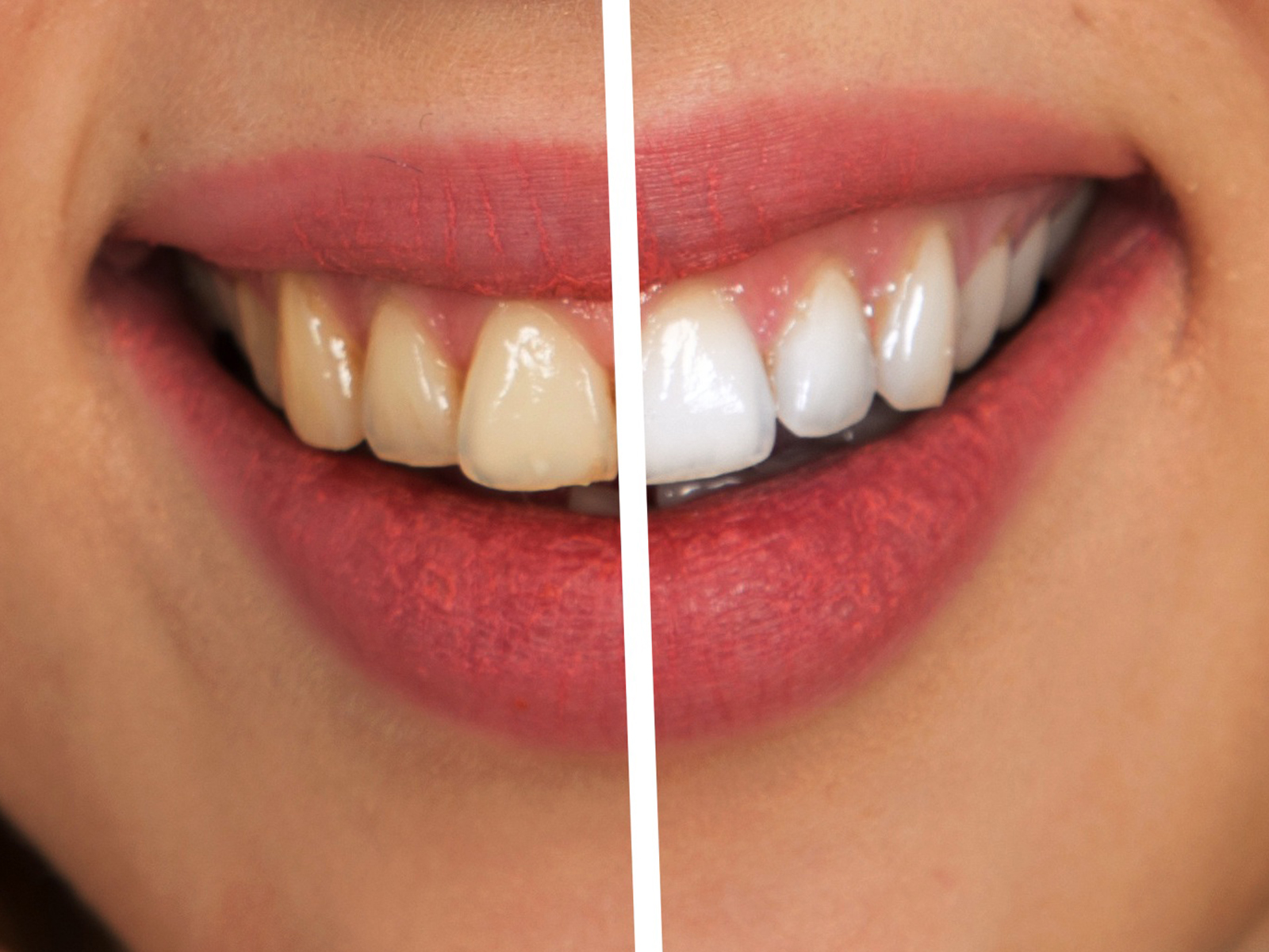 Can yellow teeth get white again?