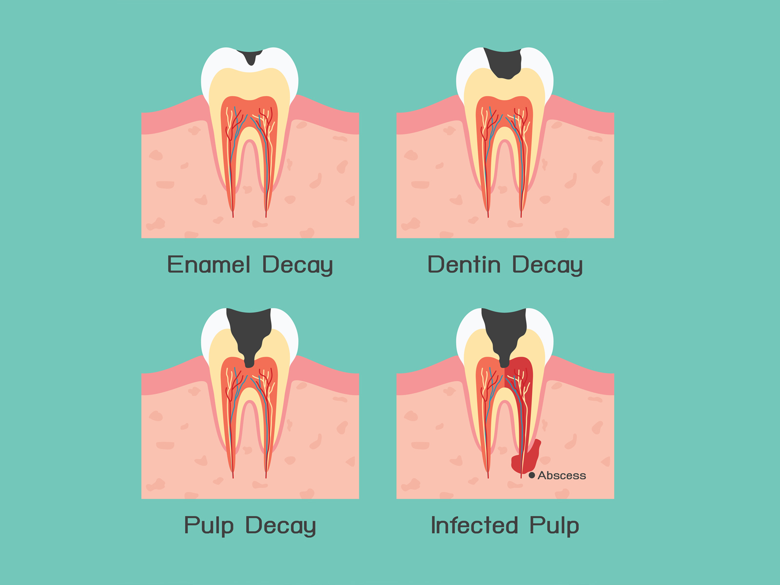 How To Treat Exposed Tooth Root?