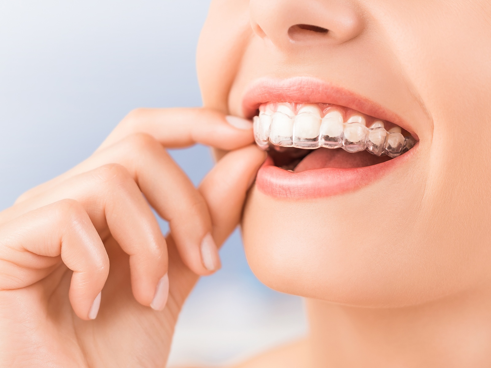 How many aligners do you get with Invisalign Lite?