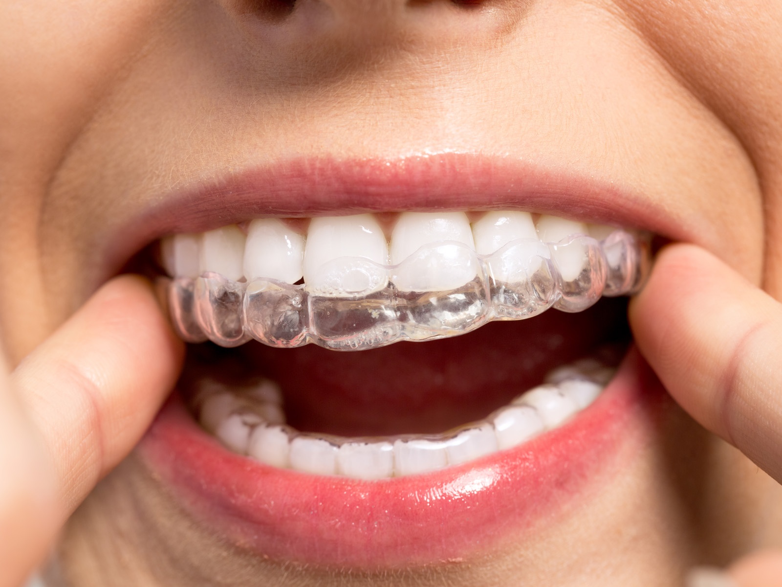 How should teeth look after Invisalign?