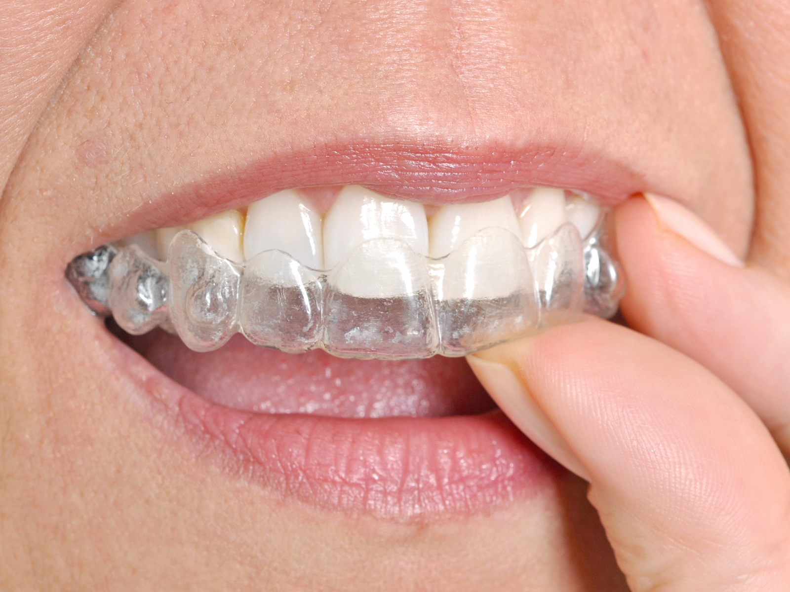What’s the shortest time for Invisalign?