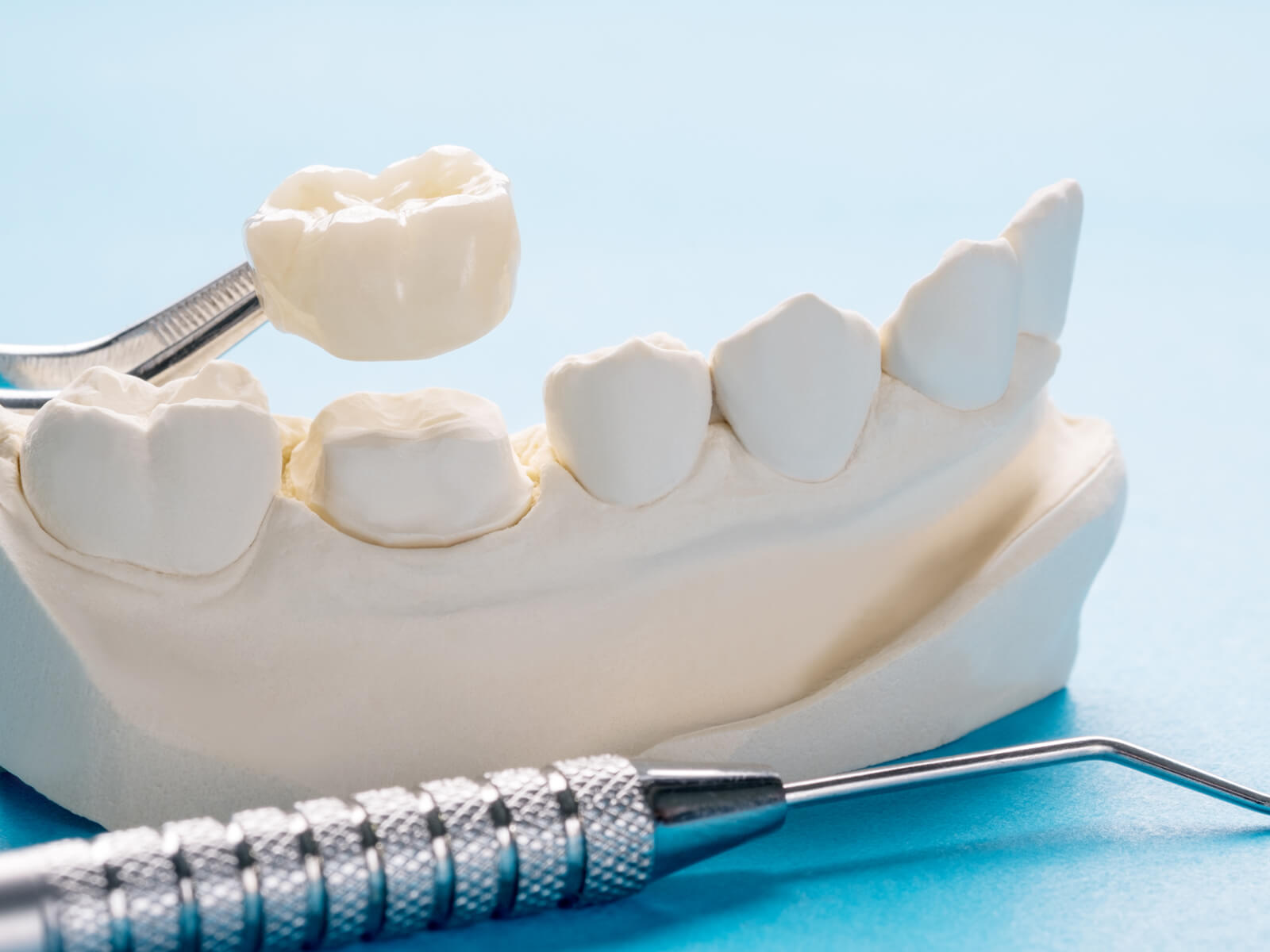 What is the Most Natural Looking Dental Crown?