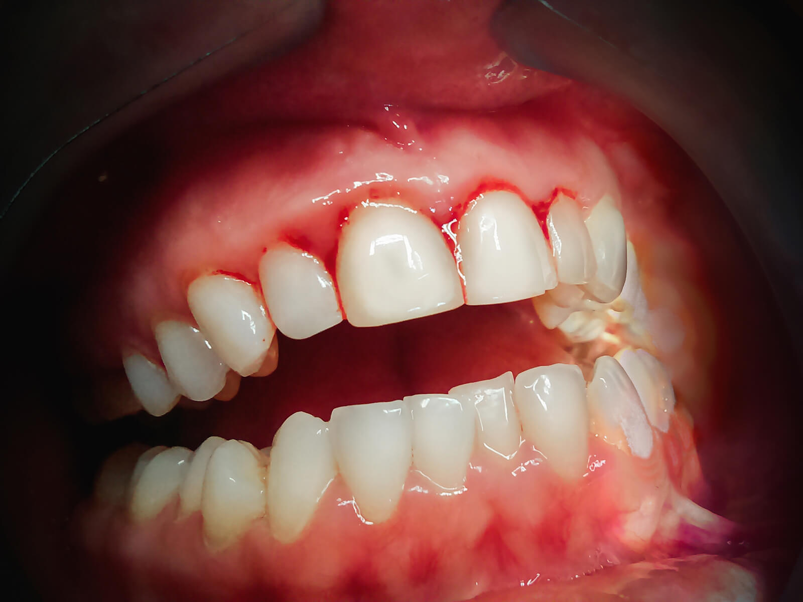How Can I Heal My Inflamed Gums?