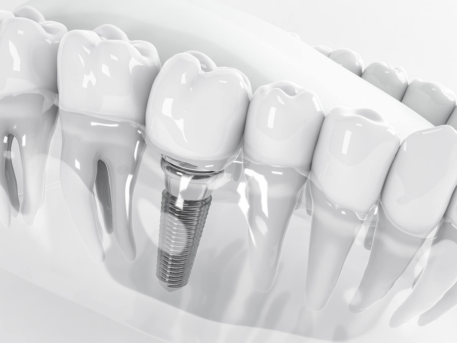 What Are The Most Common Complications of Dental Implants?