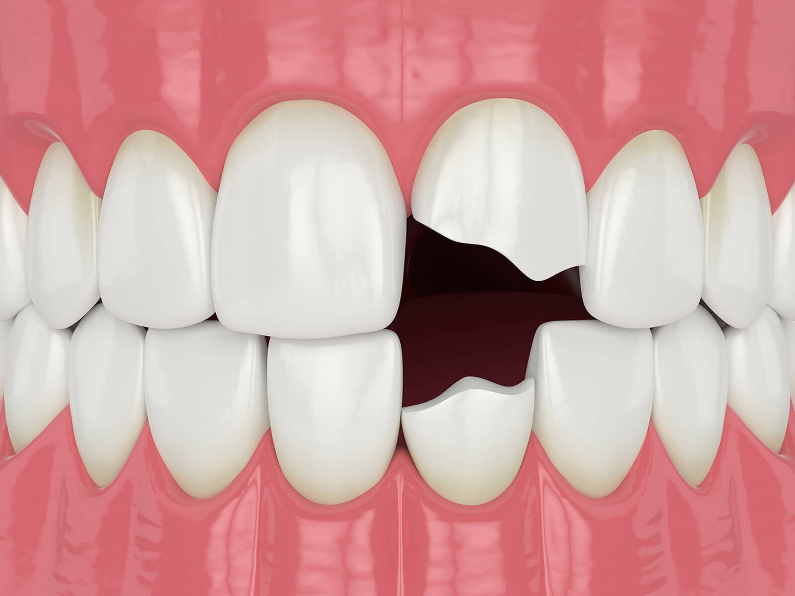 5 Ways To Help You Stop Chipping Your Teeth