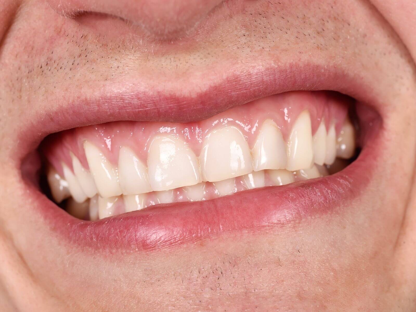 6 Steps To Prevent Receding Gums