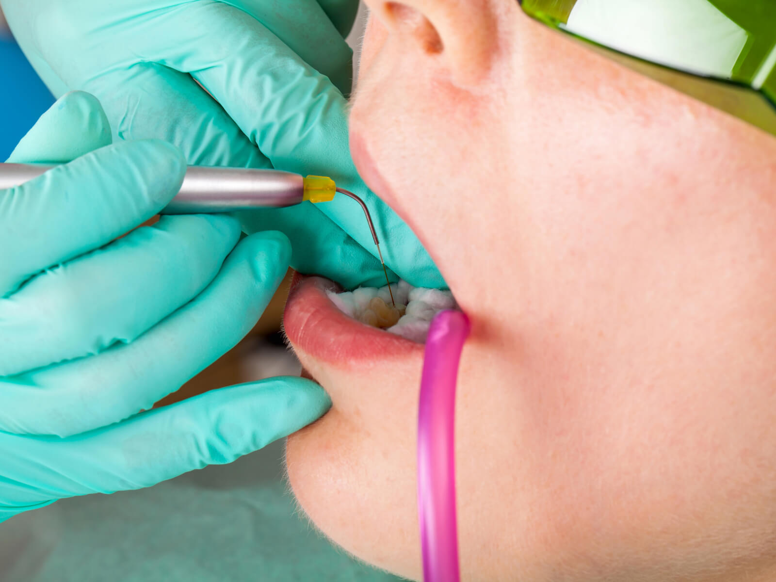 The Rise of Laser Dentistry: How It’s Changing Dental Treatments