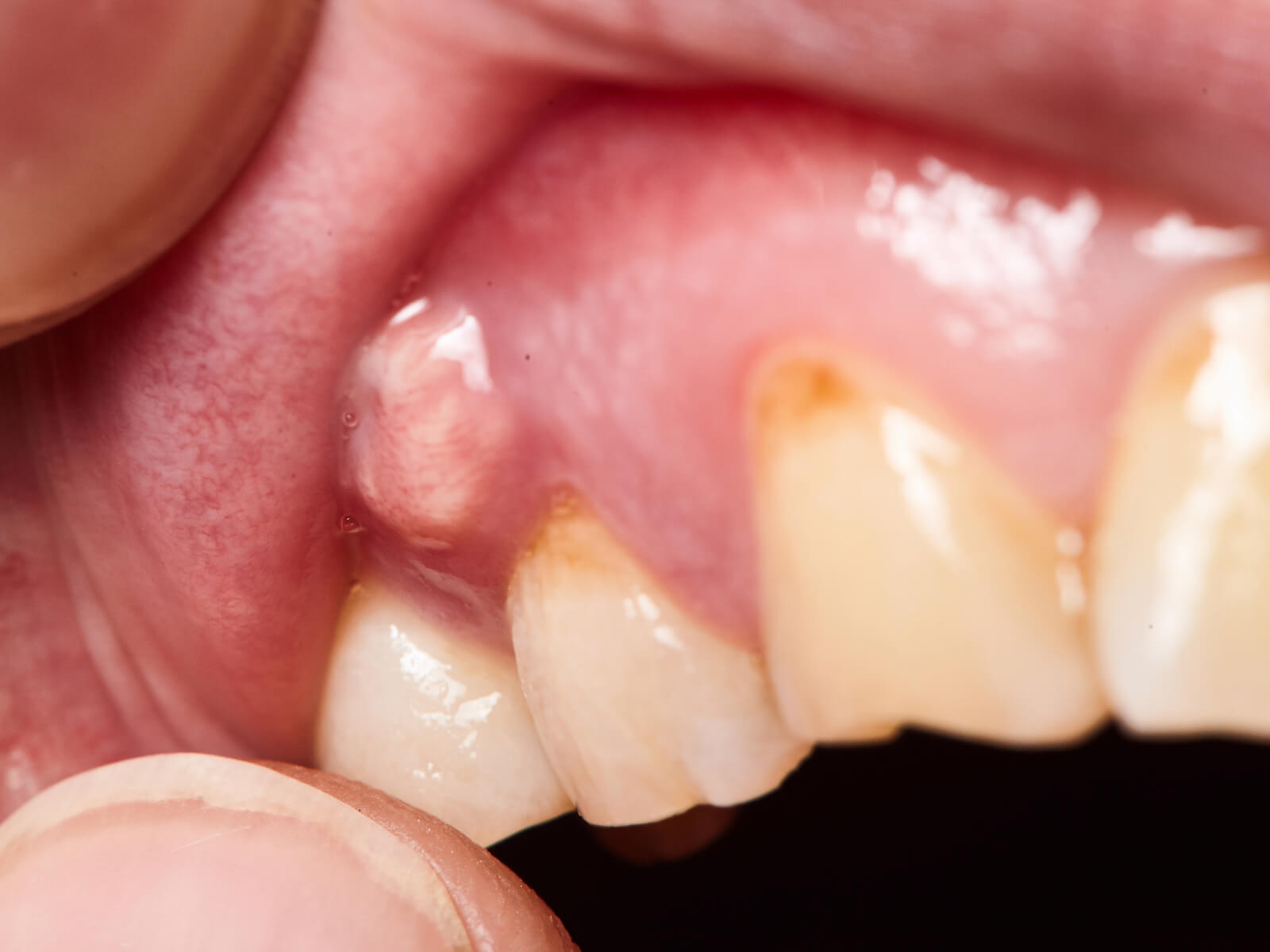 Difference Between a Tooth Abscess and Gum Abscess