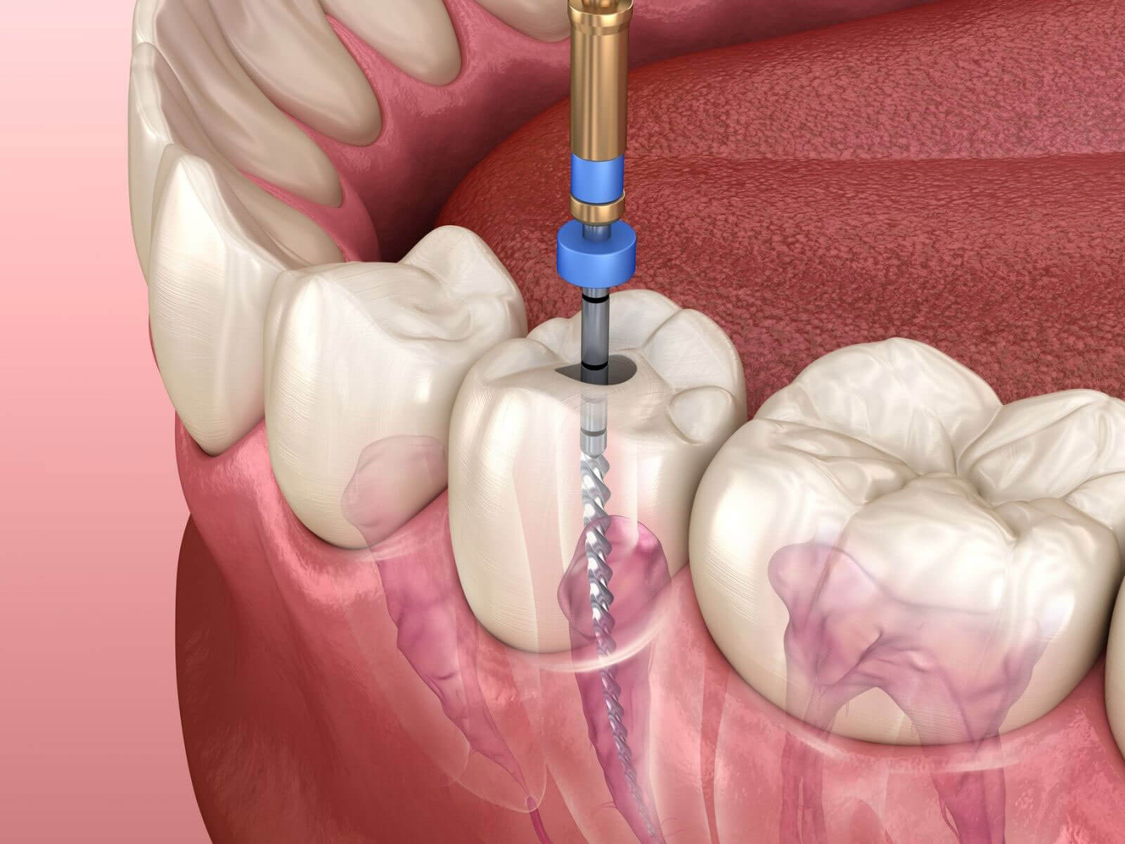 How To Recognize A Failed Root Canal Treatment