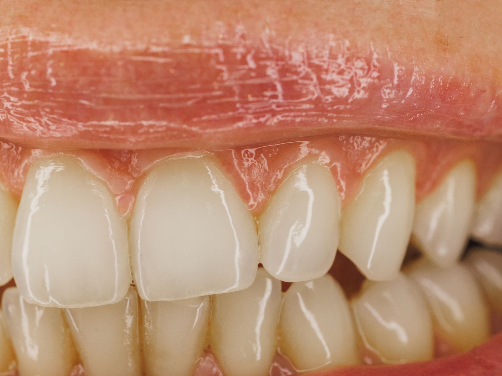 Swollen Gums: Common Causes, Treatment Options, and When to Call Your Dentist