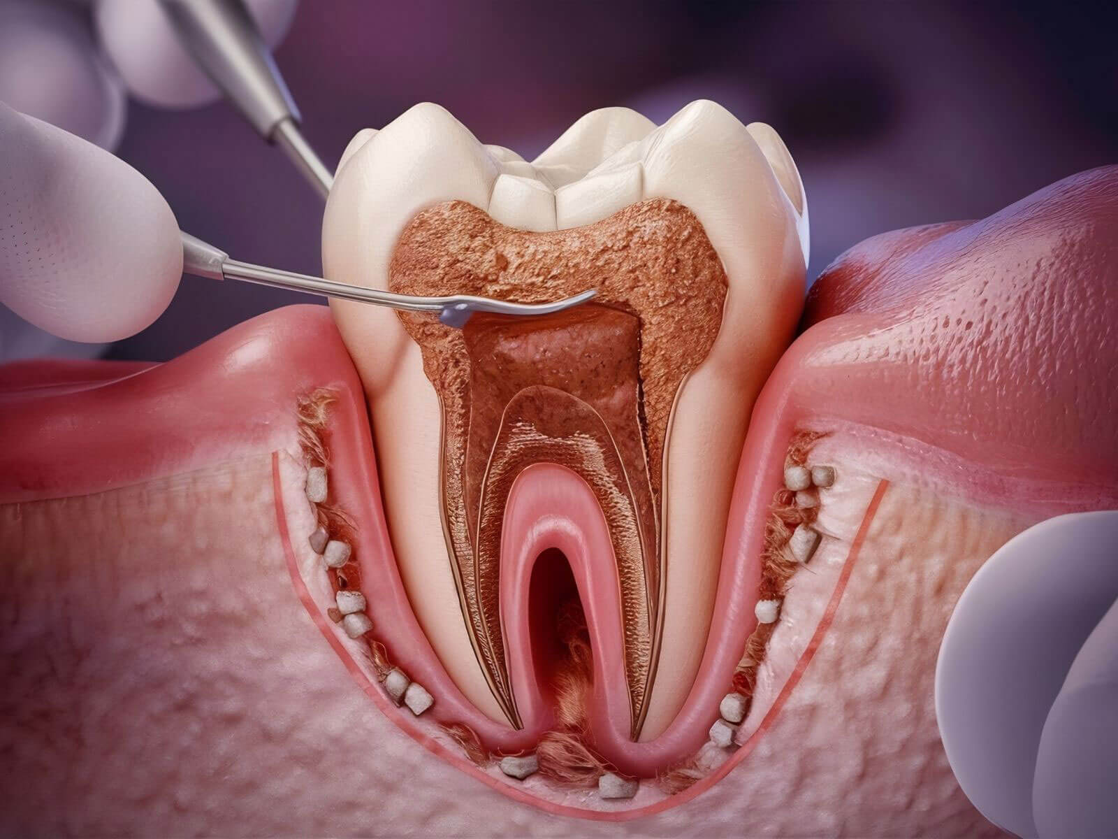 5 Stages of Tooth Decay: From White Spots to Abscess