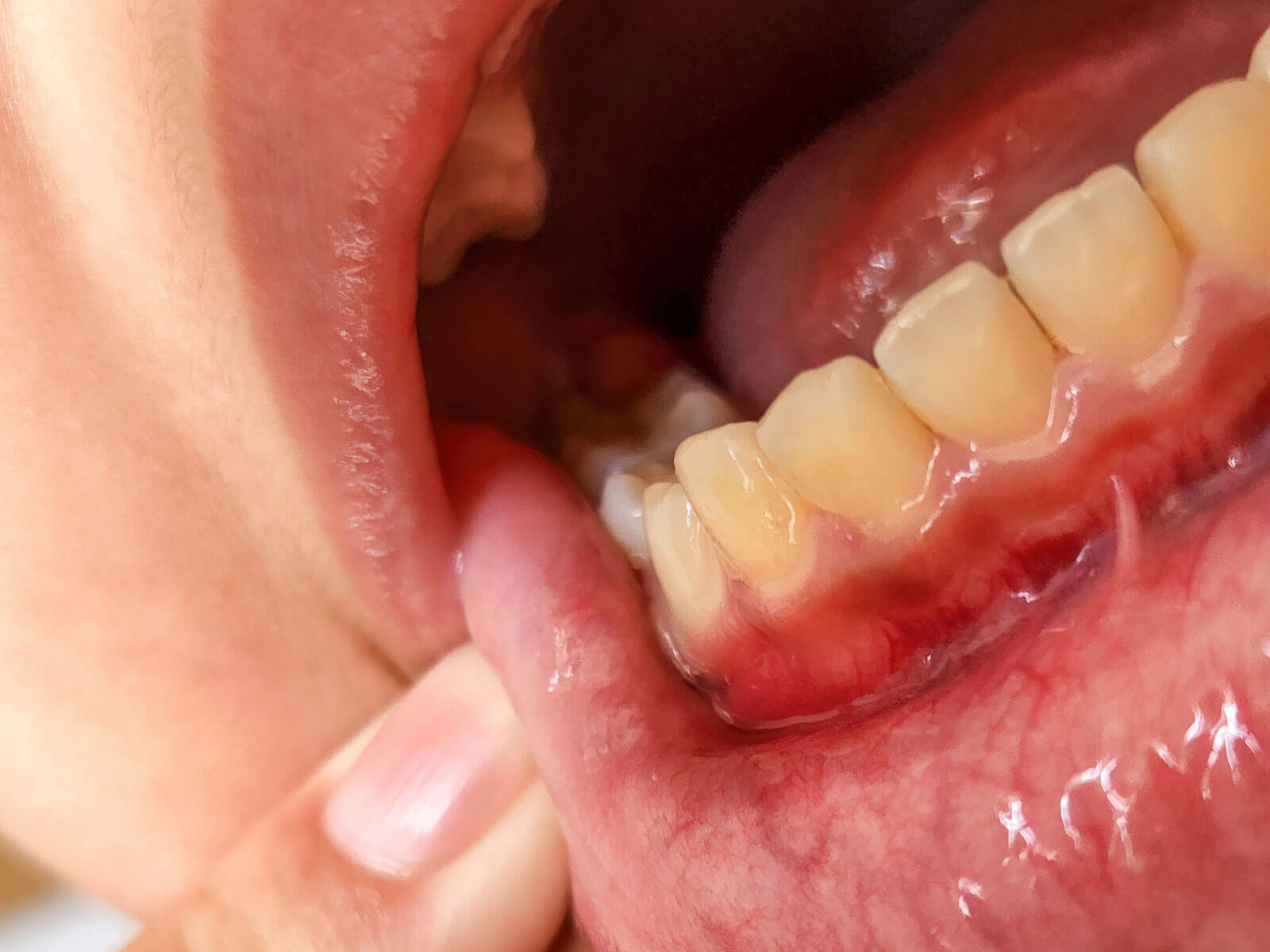 Oral Cancer Screening Benefits for Patients of All Ages